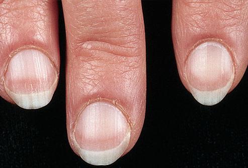 заболевание ногтей на руках