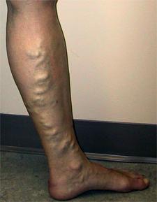 болезни ступней ног
