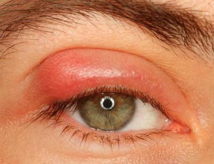 глазная мазь от воспаления век при аллергии