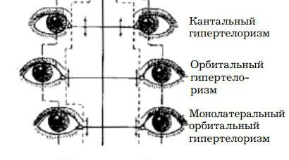 орбитальный гипертелоризм 