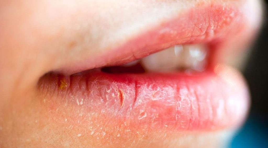 хейлит на губах симптомы лечение 