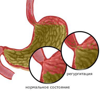 болезни пищевода симптомы лечение 