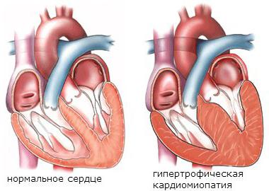 кардиомиопатия мкб 