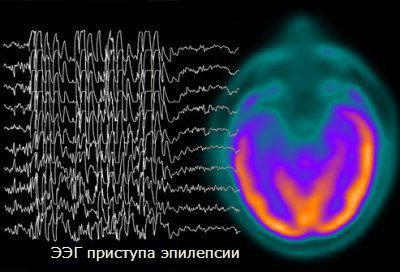 эпилепсия причины возникновения 