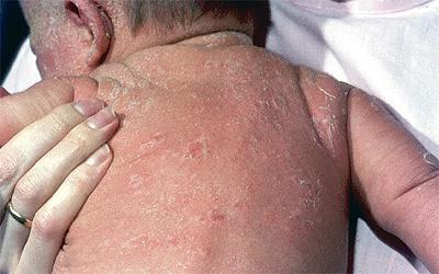 эксфолиативный дерматит у новорожденных 