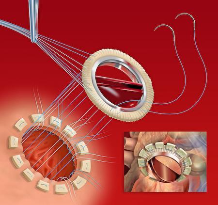 Операция на сердце. Клапан