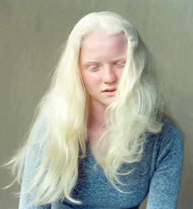 человек альбинос