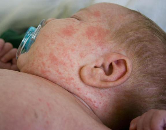 аллергия на антибиотики сыпь на коже лечение 