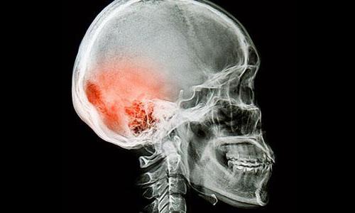 ушиб головного мозга последствия травмы 