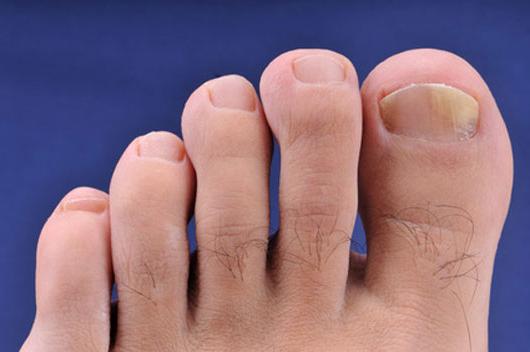 грибок ногтей на ногах лекарства