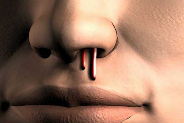 кровь из носа причины причины носового кровотечения у взрослых 