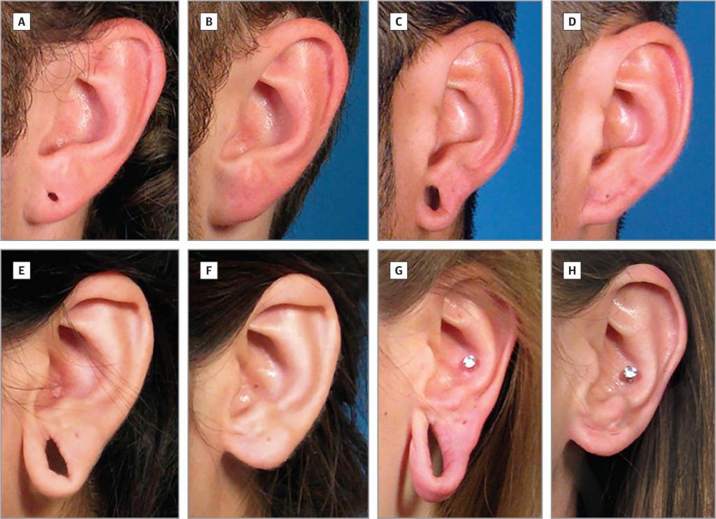 Как заращивать дырки в ушах: домашние способы и методы, обращение в салон, рекомендации, противопоказания и отзывы