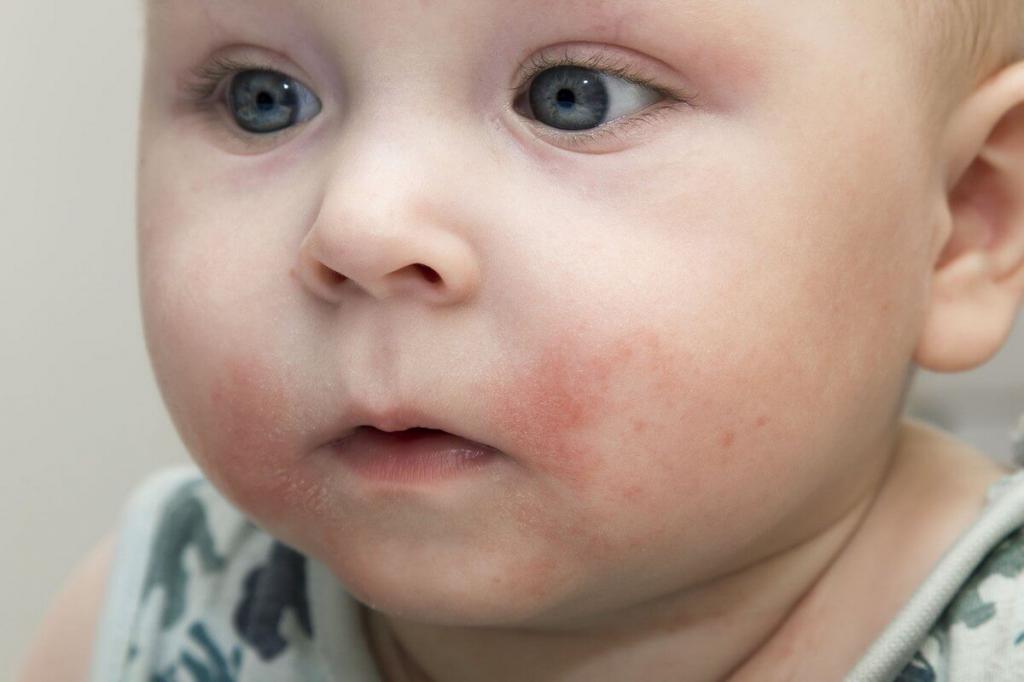 аллергия на витамин д у новорожденного