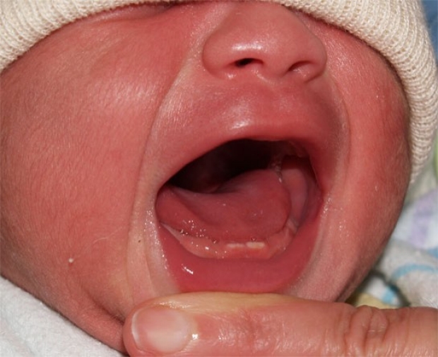 У ребенка постоянно открыт рот: причины, возможные заболевания, лечение