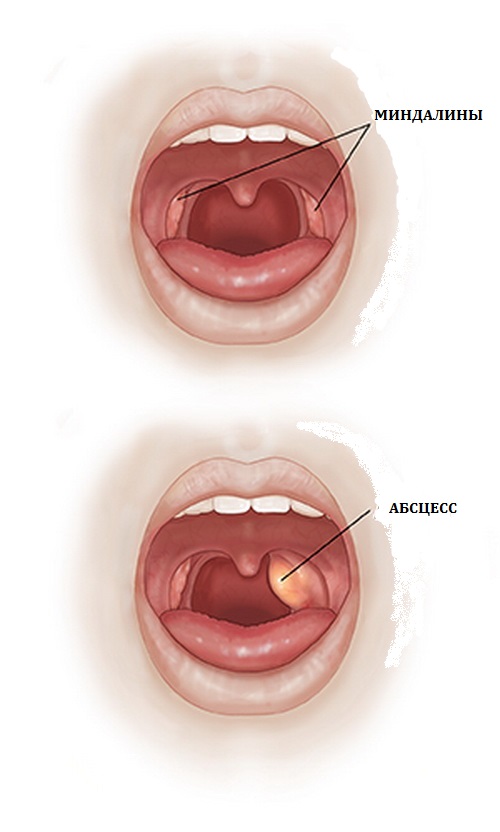 Абсцессы в горле происходят из-за наличия хронической инфекции