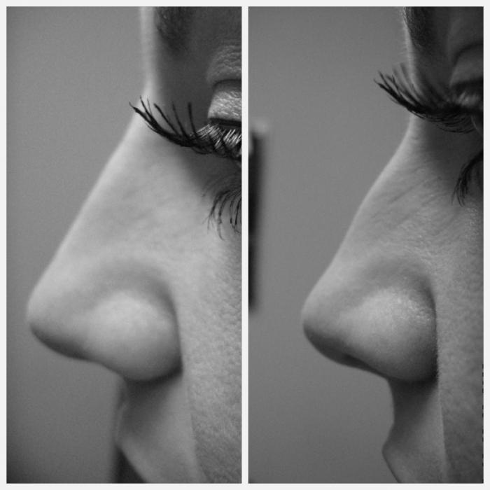 виды форм носа 
