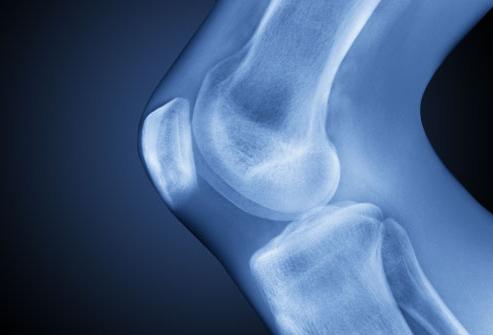 остеоартроз коленного сустава 1 степени