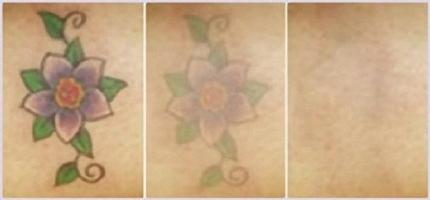 Удаление татуировок неодимовым лазером