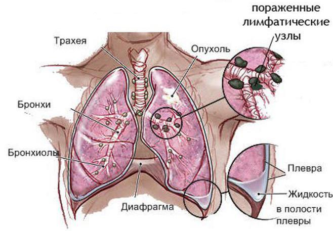 последняя стадия рака лёгких сколько живут