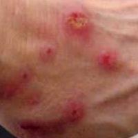 Лечение кожных заболеваний чистотелом