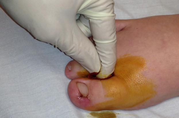 Нарывает палец на ноге лечение