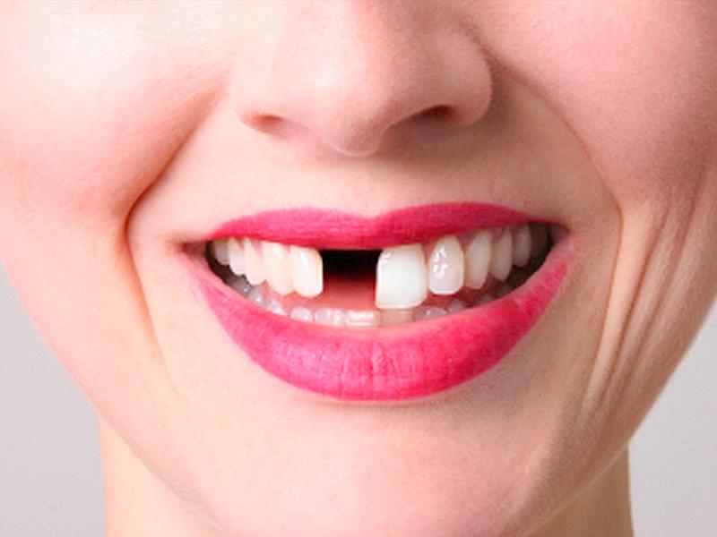 К чему снится, что выпало много зубов без крови?