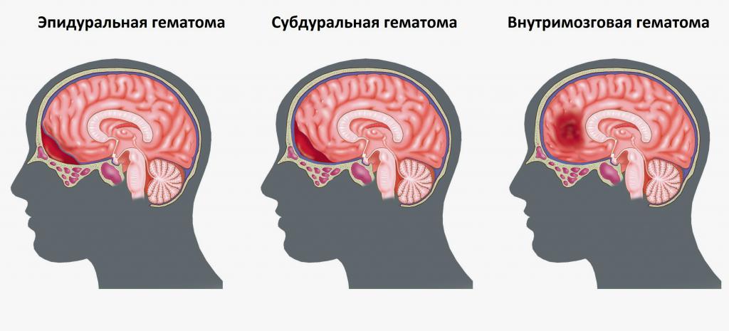Типы гематом мозга