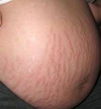 крем от растяжек во время беременности