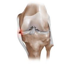 частичный разрыв связок коленного сустава