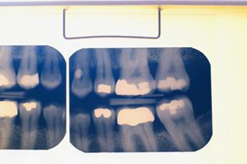 классификация дефектов твердых тканей зубов по блэку