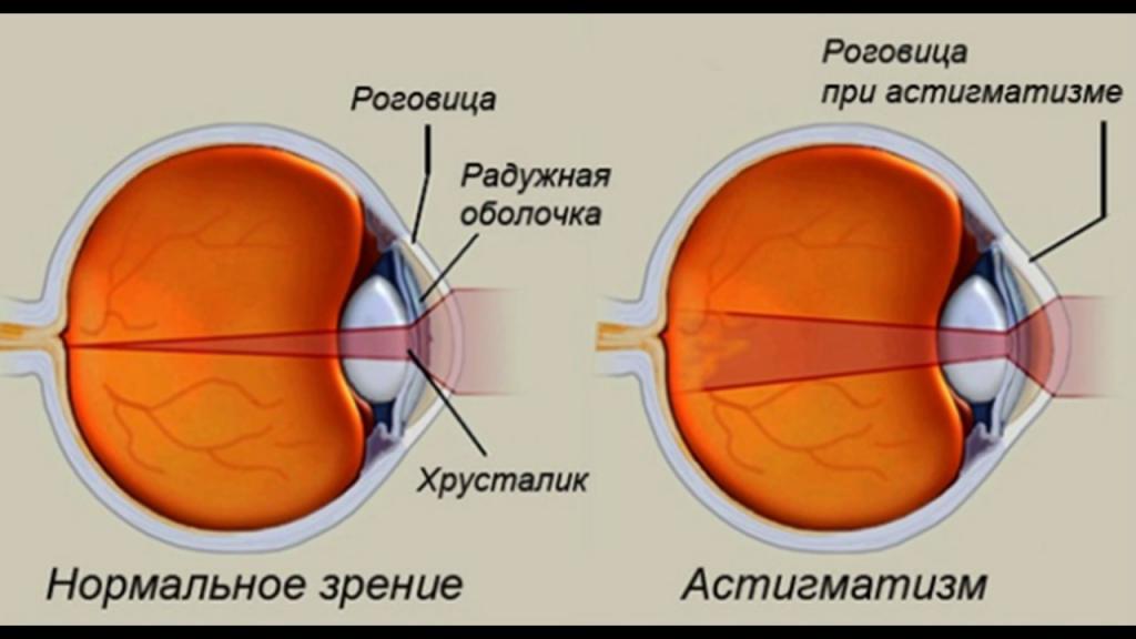 Как выглядит глаз при астигматизме.