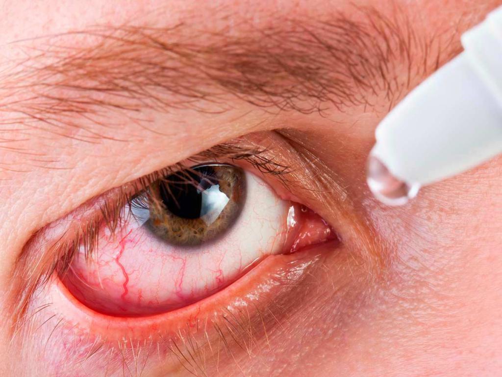 Лечение синдрома красного глаза.