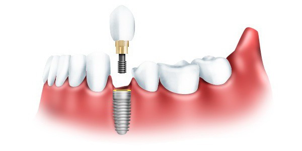 виды имплантов зубов