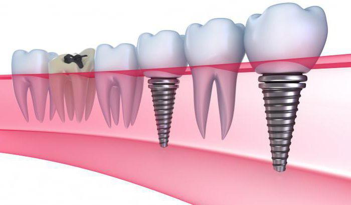  виды имплантов для зубов от разных производителей