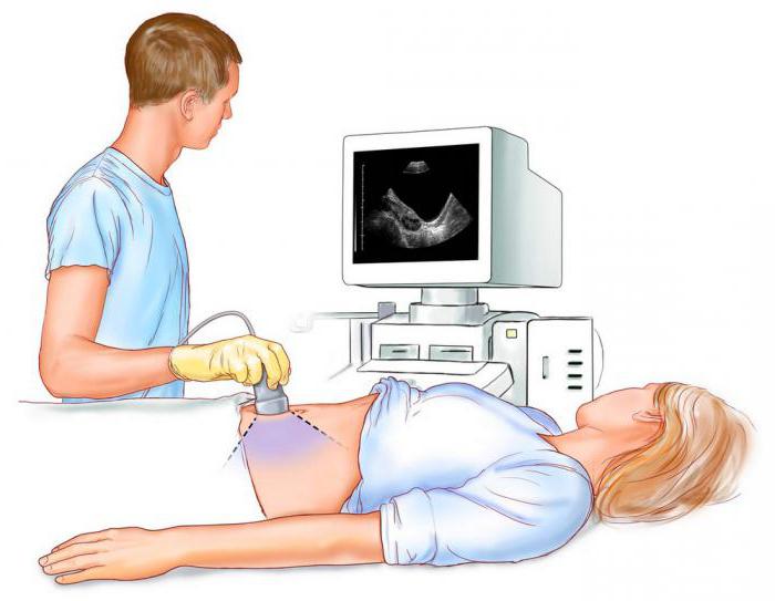  трубная беременность по типу трубного аборта