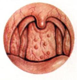 волдыри в горле на задней