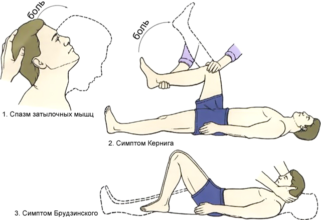 симптомы кернига и брудзинского