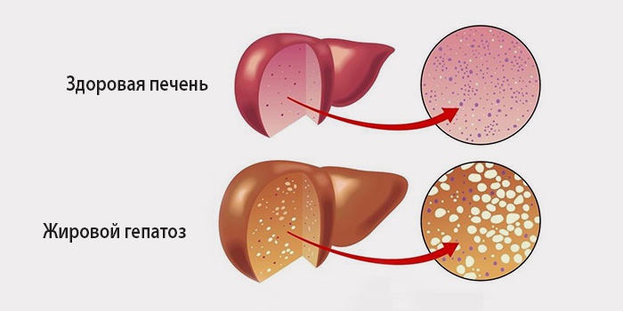 Что из себя представляет жировой гепатоз