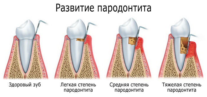 стадии пародонтита