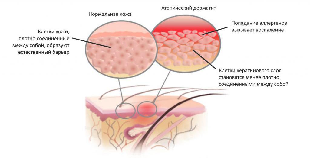 механизм развития атопического дерматита