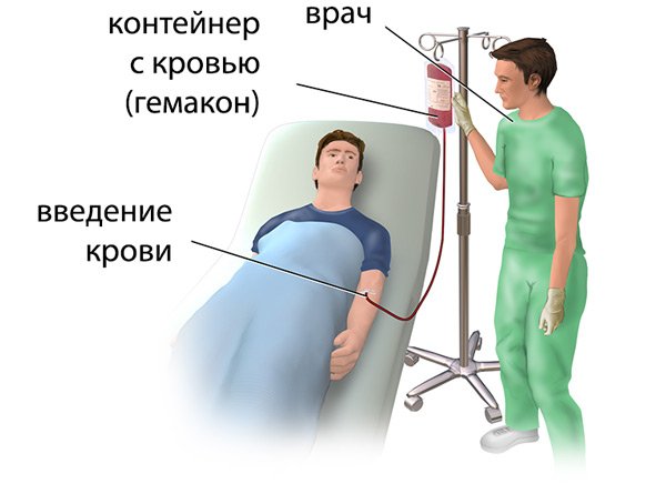 техника переливания крови