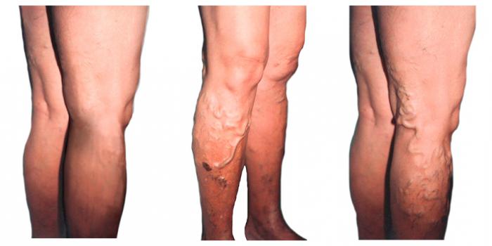 крем против варикоза varicose veins отзывы и советы 