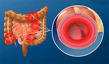 язвенный колит кишечника симптомы лечение 