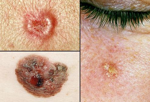 рак кожи начальная стадия