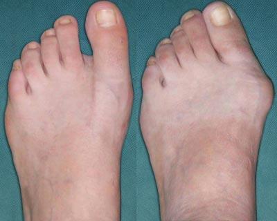 болезни стопы ног лечение