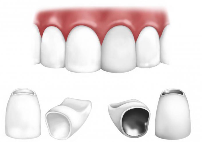 безметалловые коронки цены
