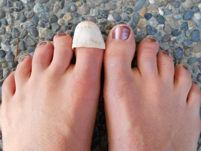 отслоение ногтя на большом пальце ноги причины