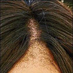 выпадение волос алопеция 