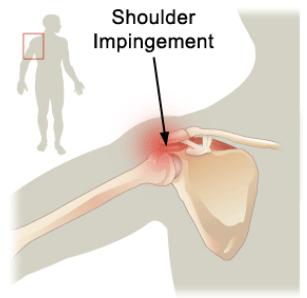 импинджмент синдром плечевого сустава лечение