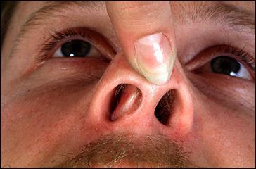 эндоскопические операции носа